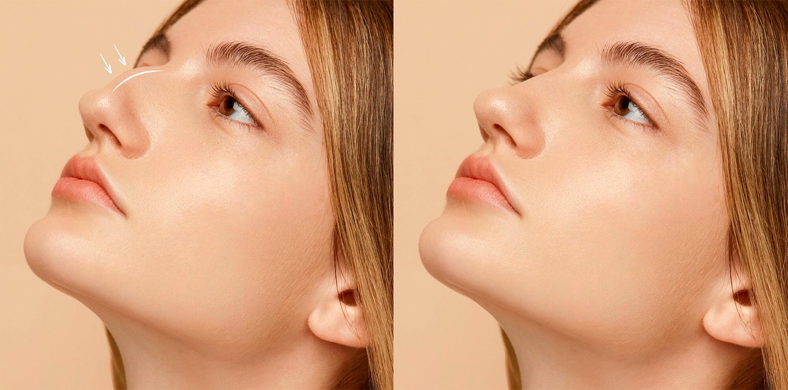 nose-surgery-before-after